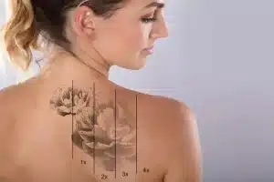 The Ultimate Guide to Finding Trusted Tattoo Removal Specialists