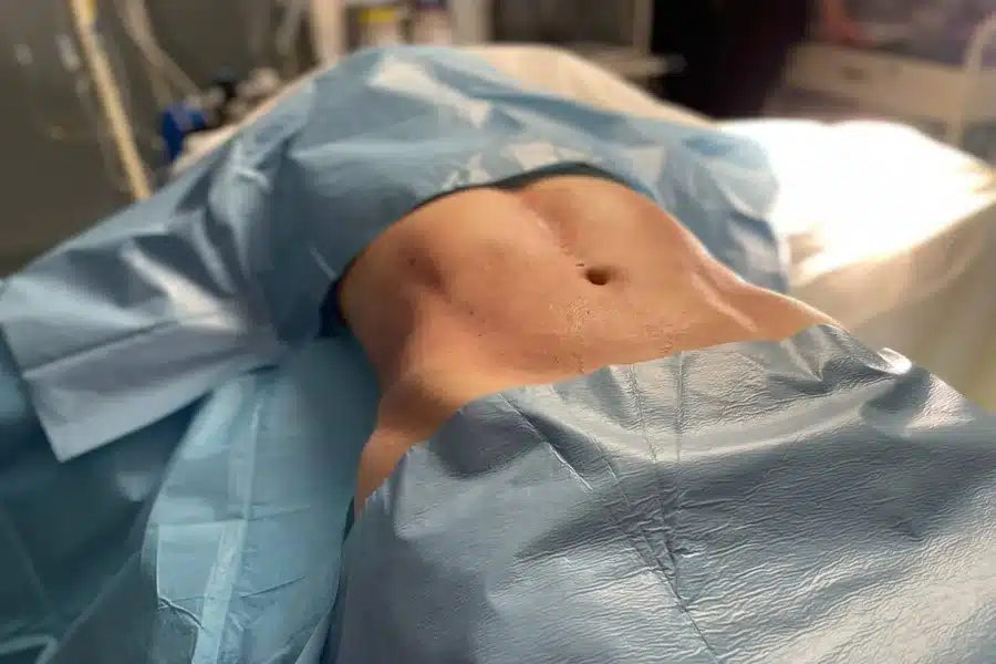 Liposuction