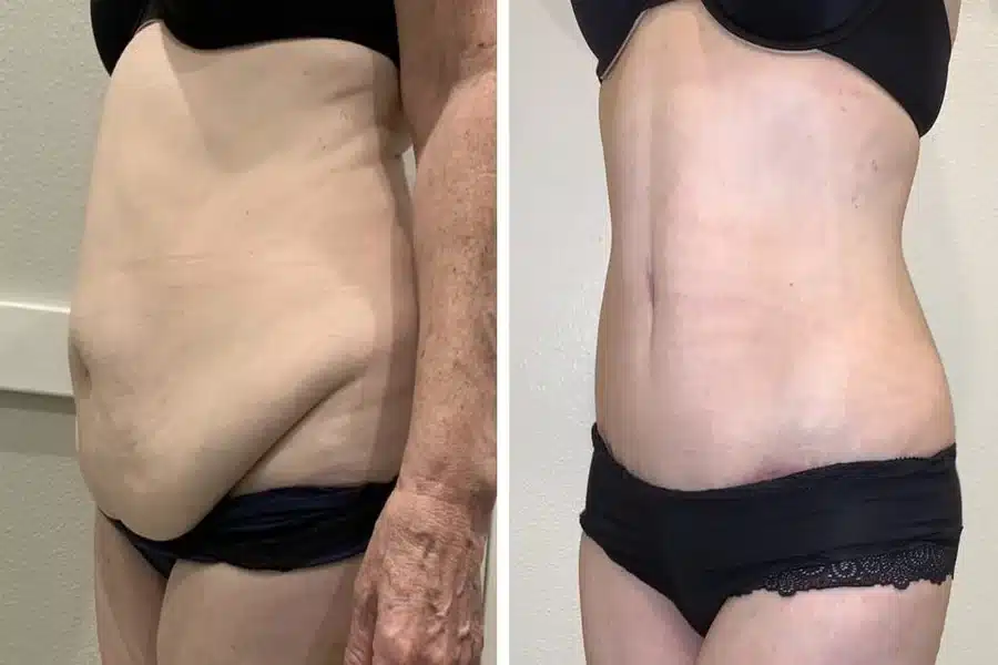 Liposuction