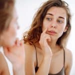 Adult Acne