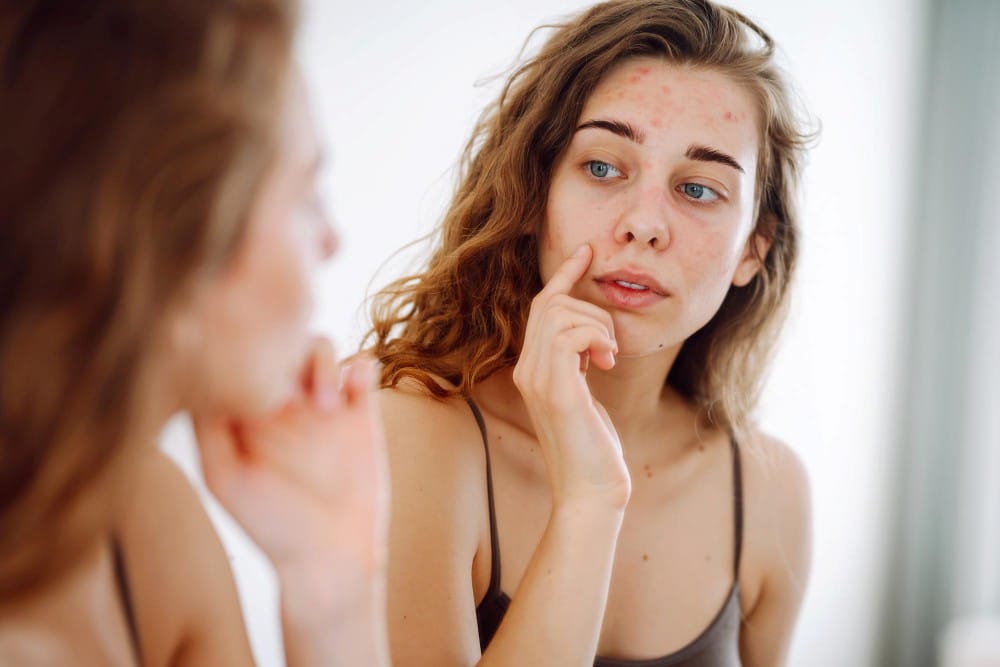 Adult Acne